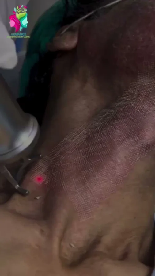 Acne, scars and skin resurfacing