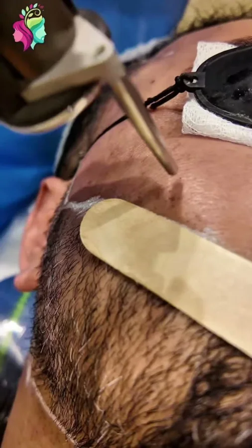 Laser beard-line shaping
