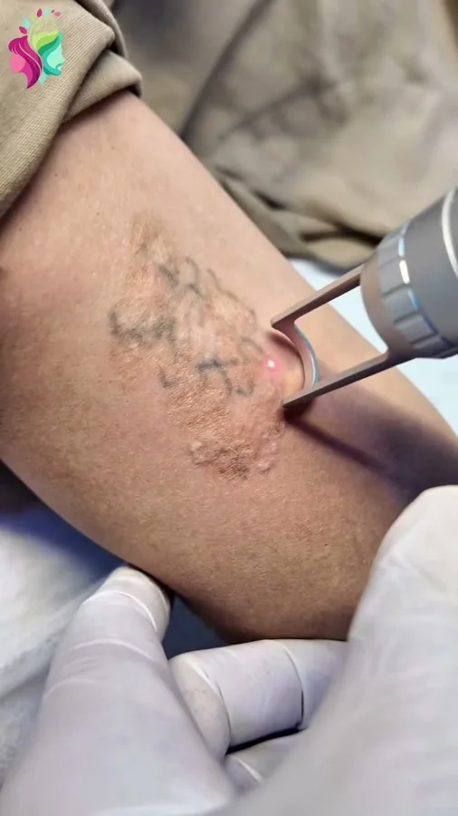 Tattoo removal