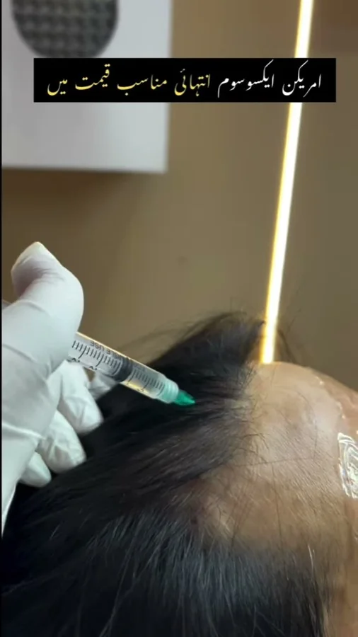 Hair fall and hair restoration