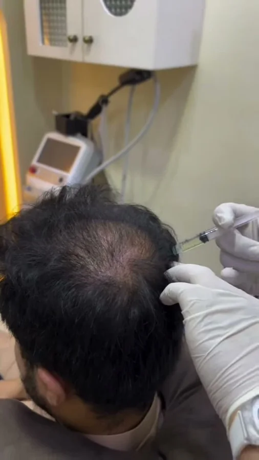 Hair fall and hair restoration