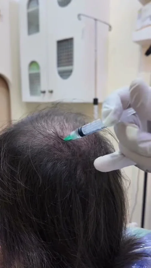 Hair fall and hair restoration