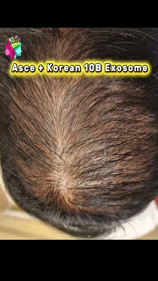 Hair fall and hair restoration