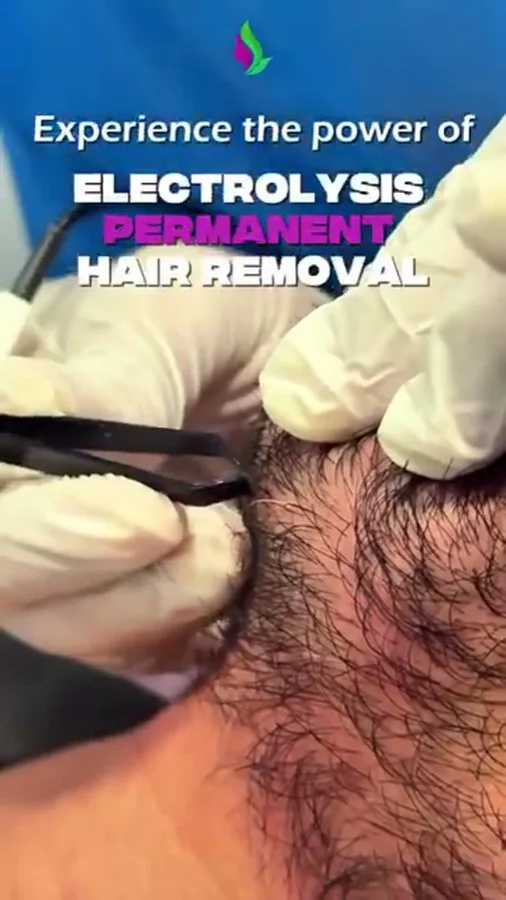 Laser hair removal