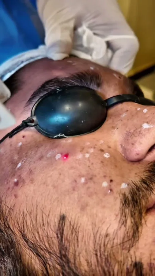 Pigmentation, melasma and freckles