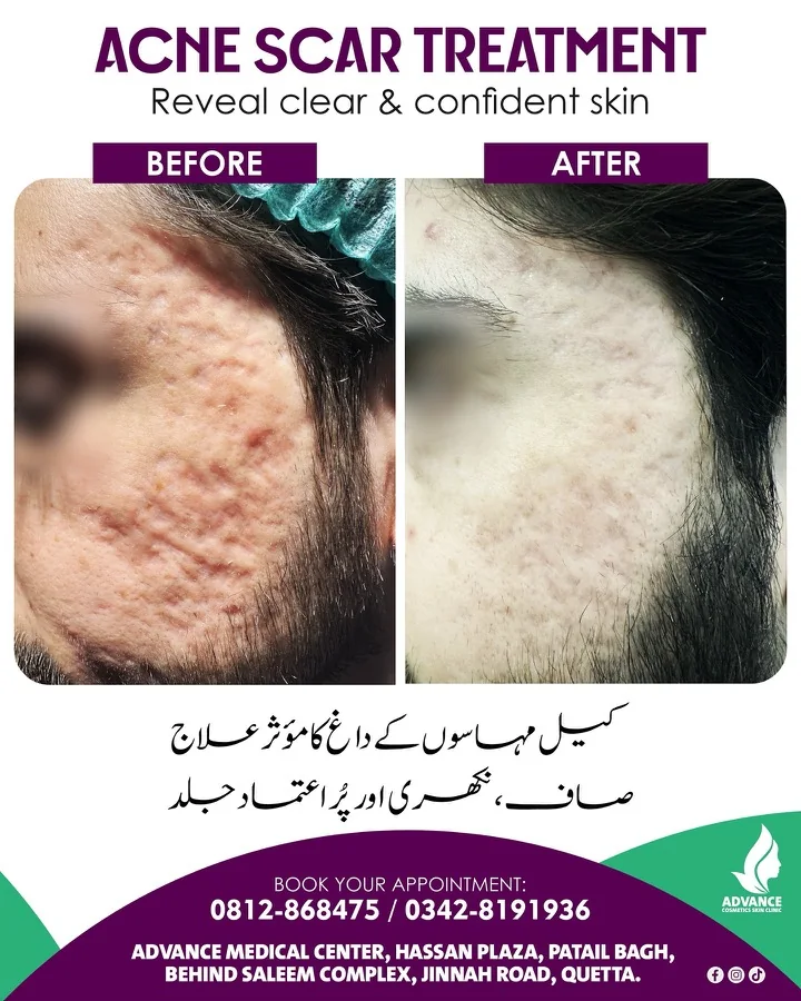Acne, scars and skin resurfacing