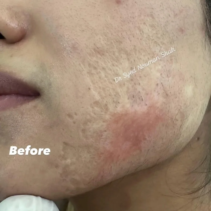 Acne, scars and skin resurfacing