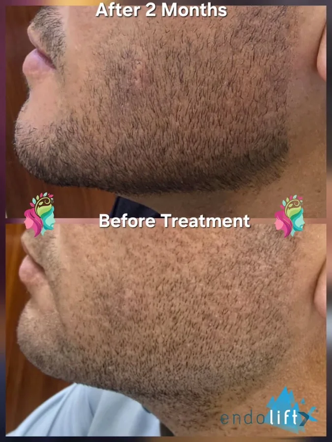 Laser beard-line shaping