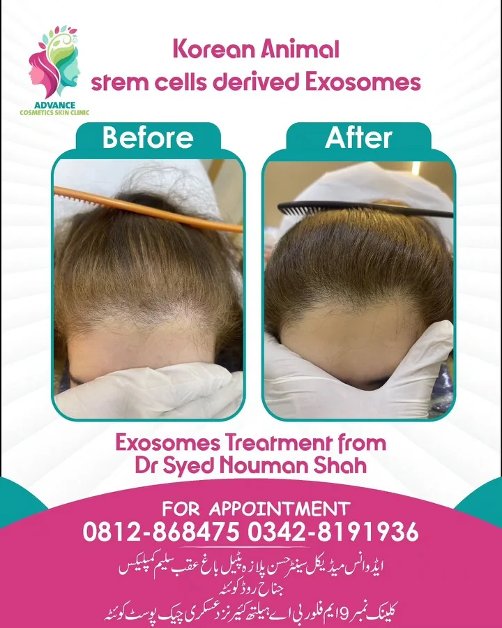 Hair fall and hair restoration