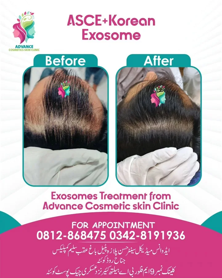 Hair fall and hair restoration