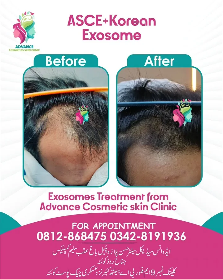 Hair fall and hair restoration