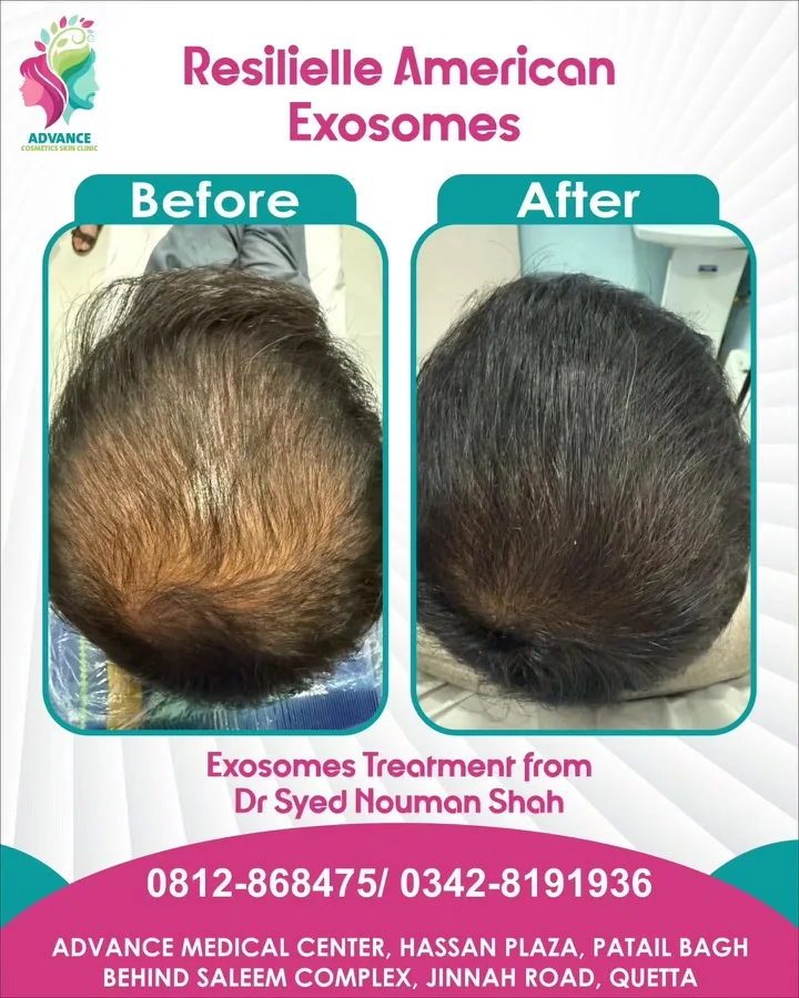 Hair fall and hair restoration