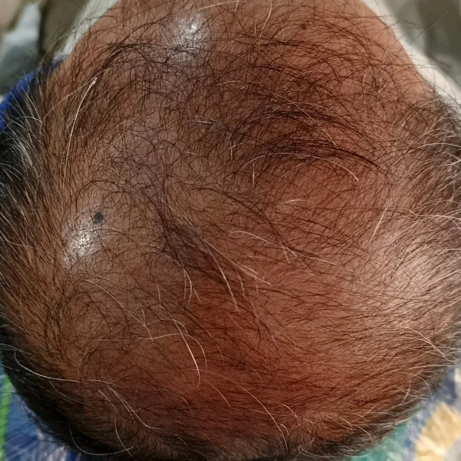 Hair fall and hair restoration