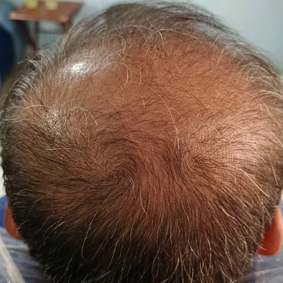 Hair fall and hair restoration