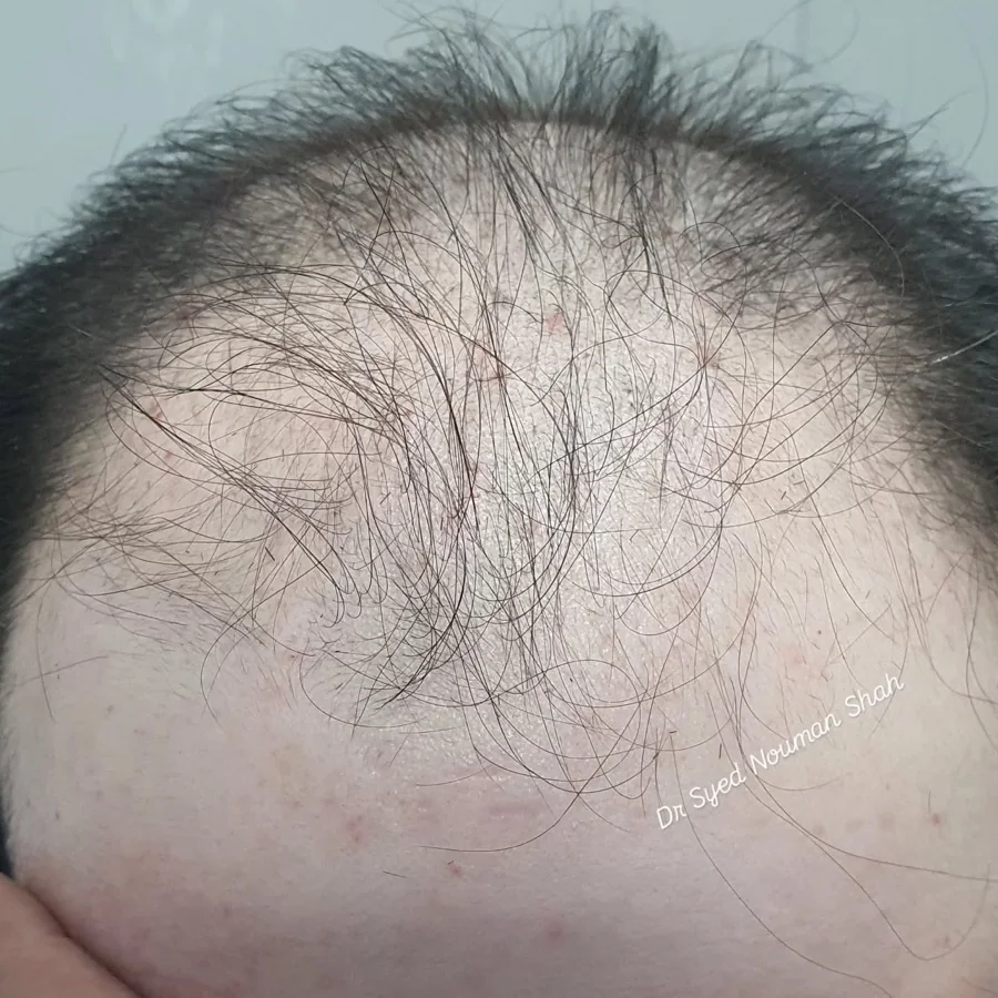 Hair fall and hair restoration