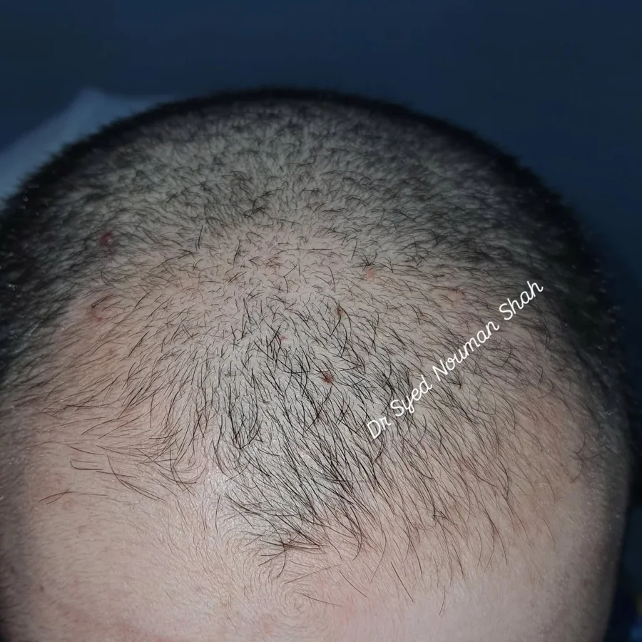 Hair fall and hair restoration