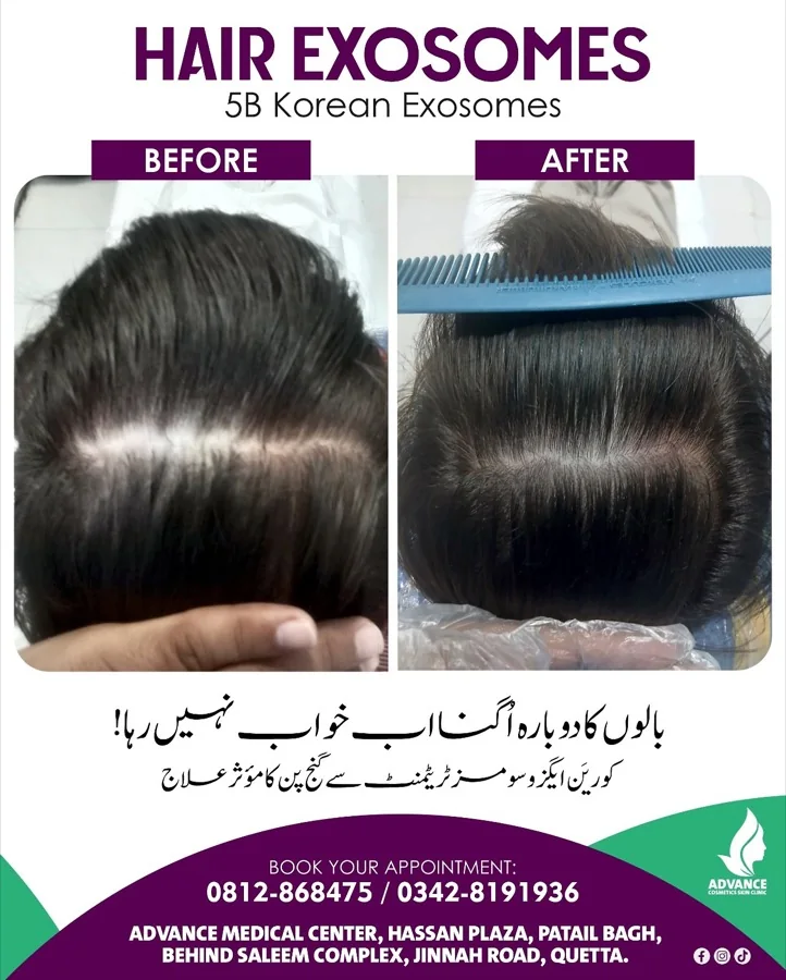 Hair fall and hair restoration