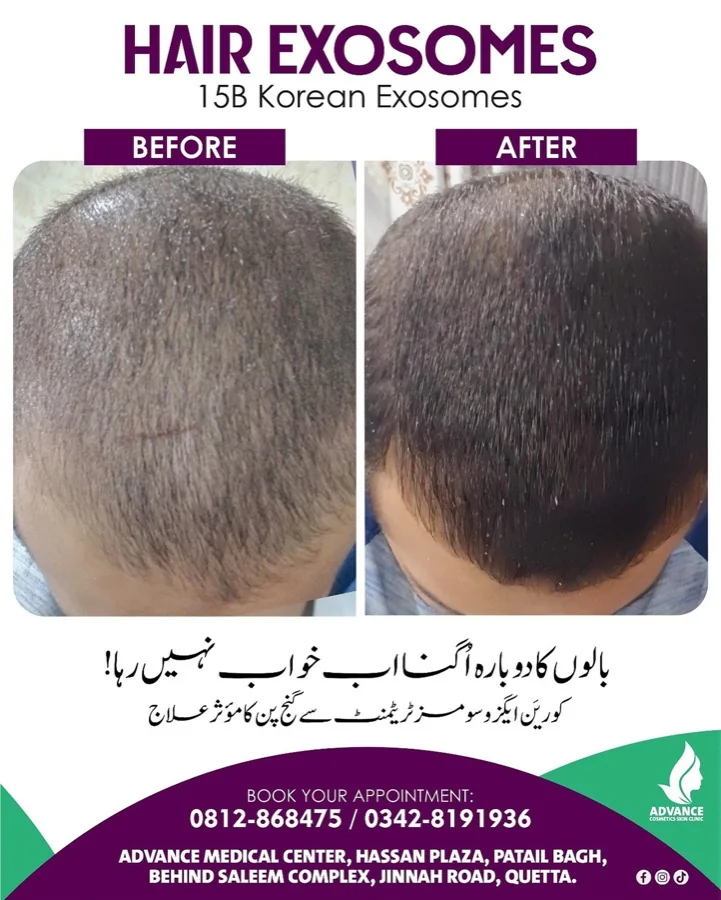 Hair fall and hair restoration