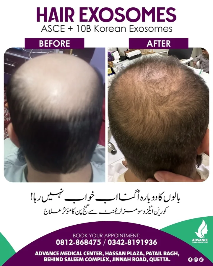 Hair fall and hair restoration