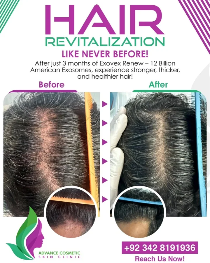 Hair fall and hair restoration