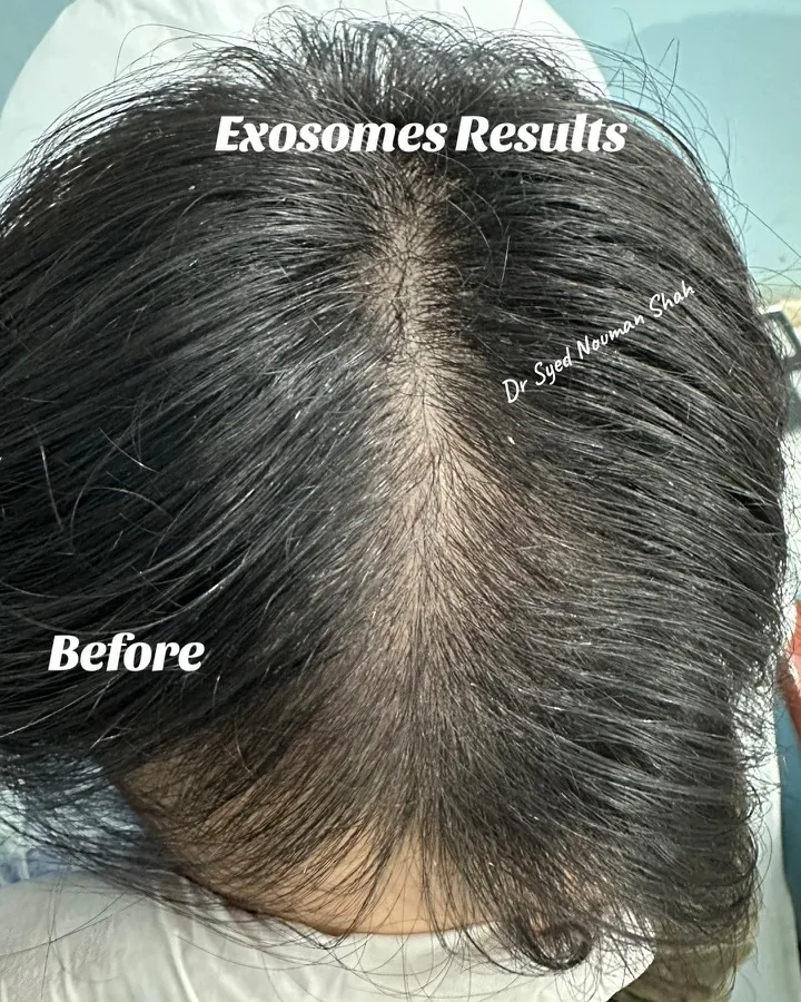 Hair fall and hair restoration