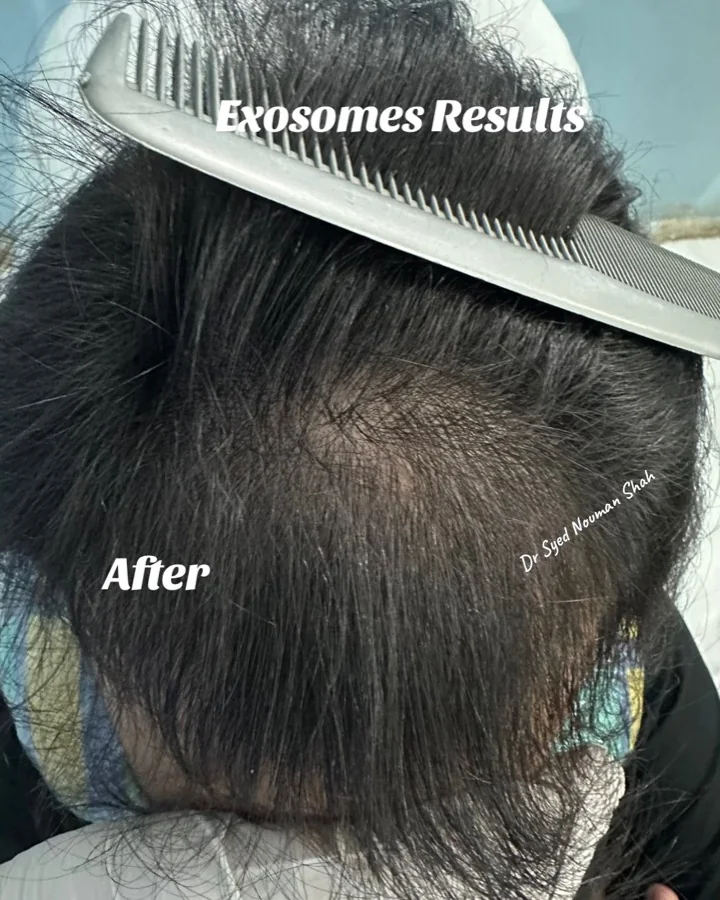 Hair fall and hair restoration
