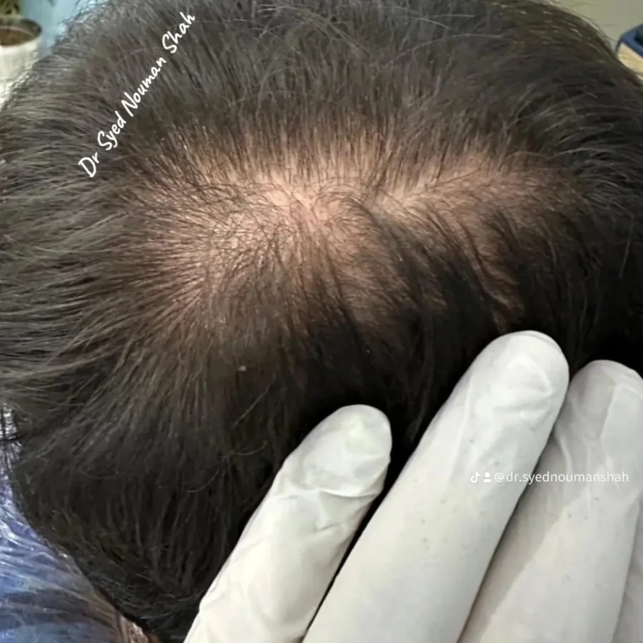 Hair fall and hair restoration