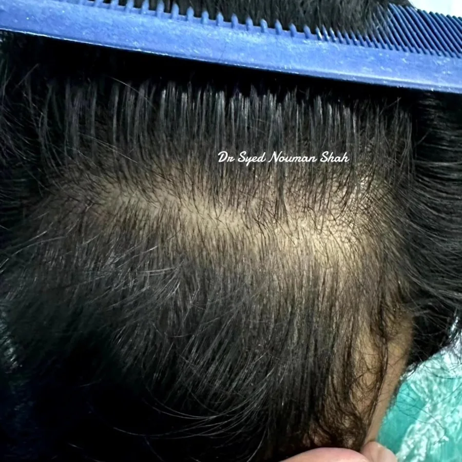 Hair fall and hair restoration