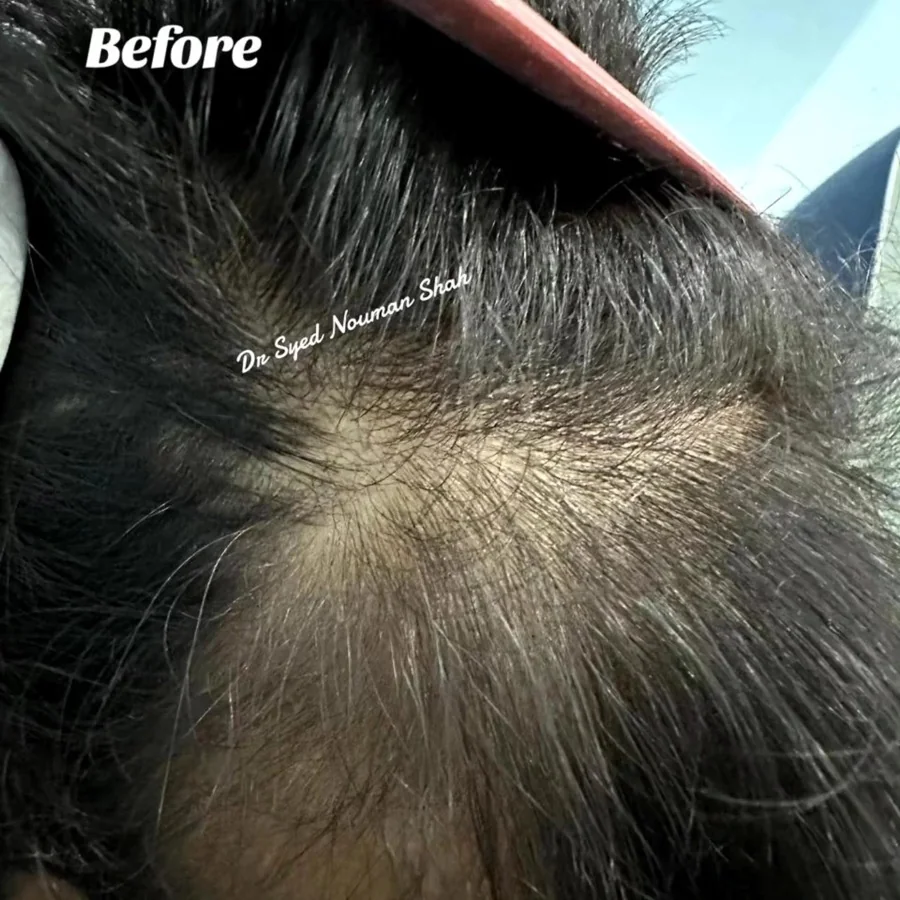 Hair fall and hair restoration