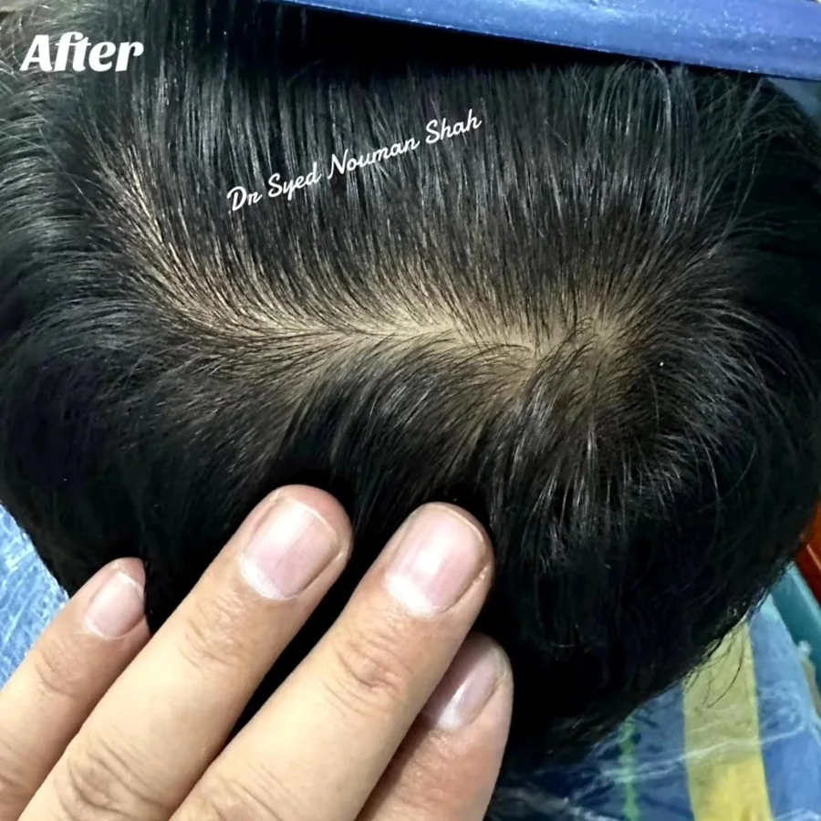 Hair fall and hair restoration
