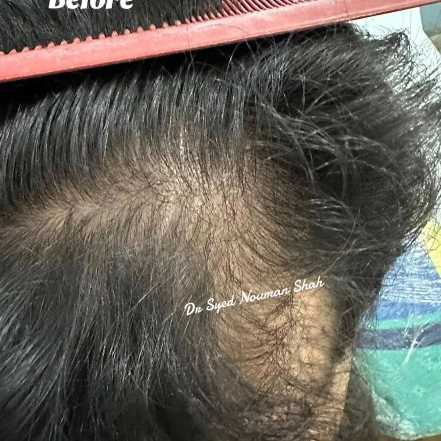 Hair fall and hair restoration