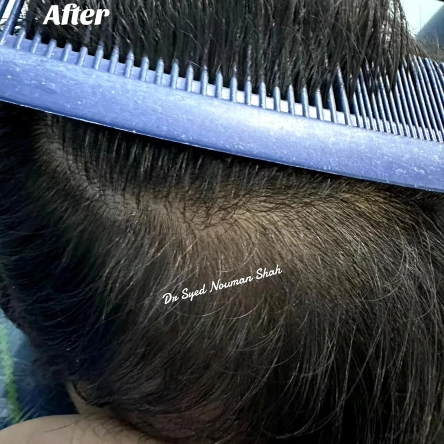 Hair fall and hair restoration