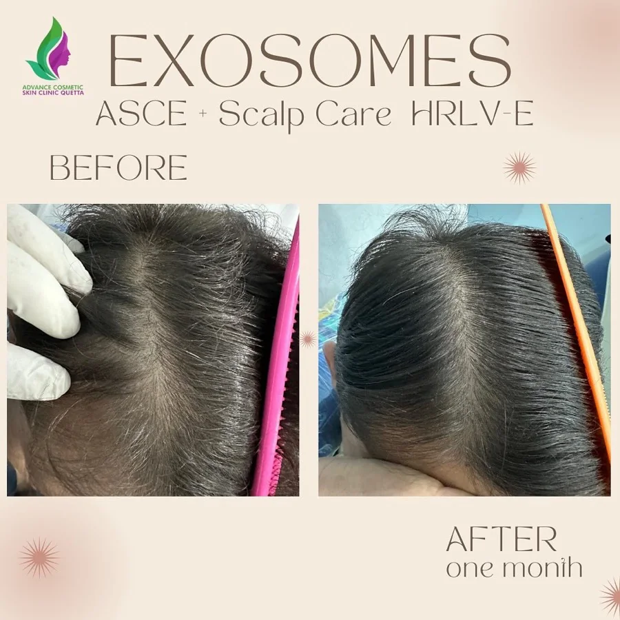 Hair fall and hair restoration