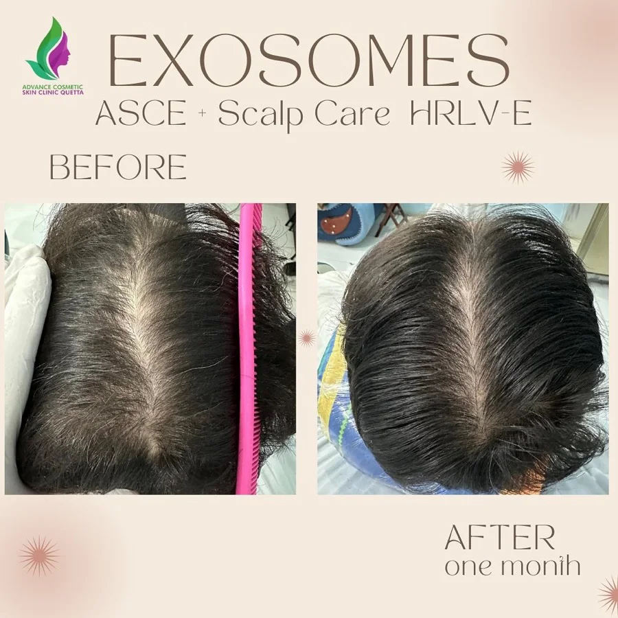 Hair fall and hair restoration