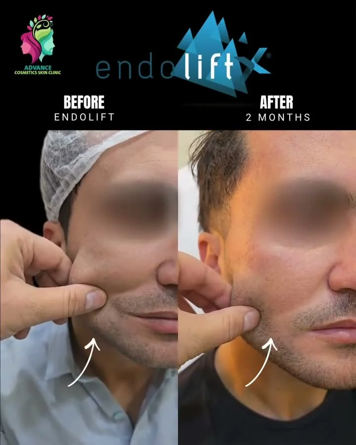 Skin lifting, tightening and rejuvenation