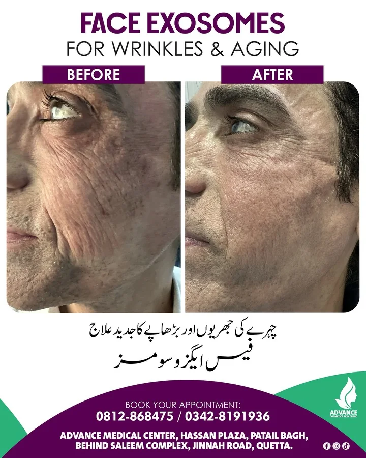 Skin lifting, tightening and rejuvenation