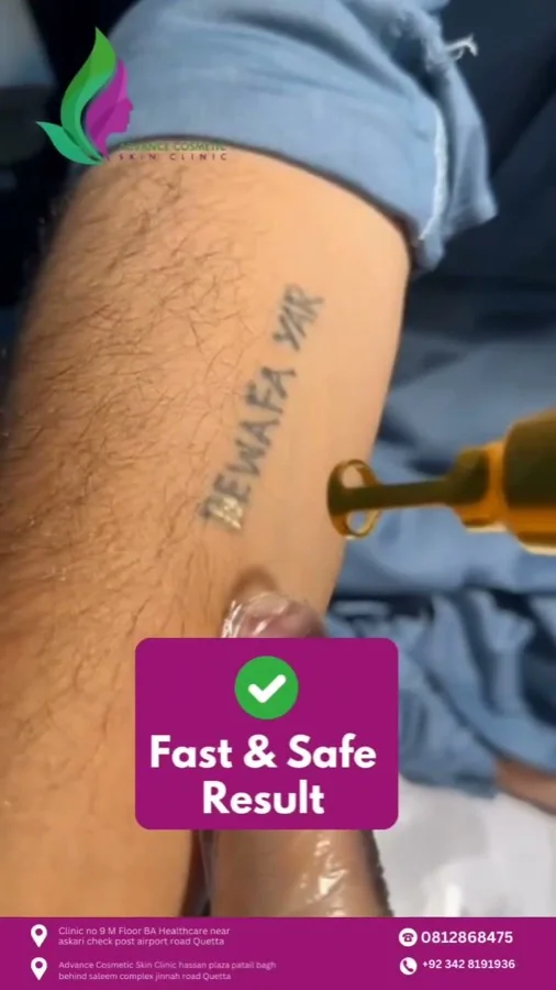 Tattoo removal