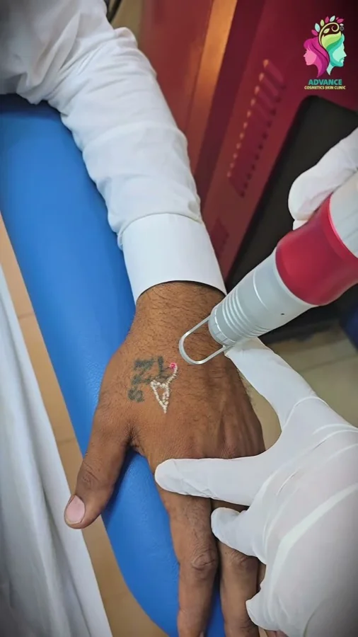 Tattoo removal
