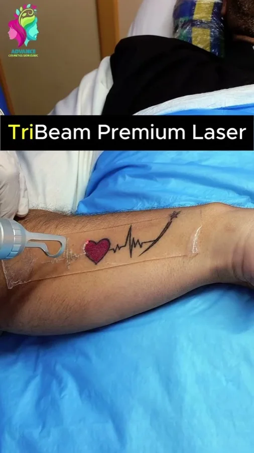 Tattoo removal