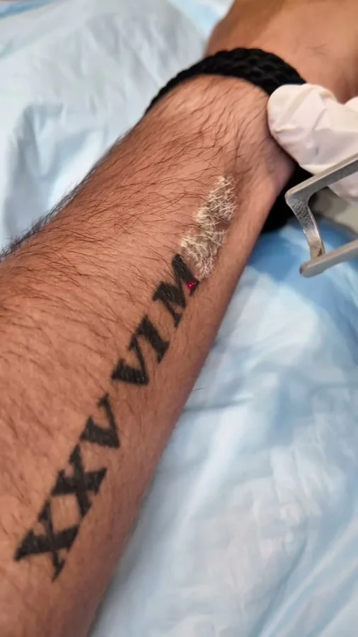 Tattoo removal